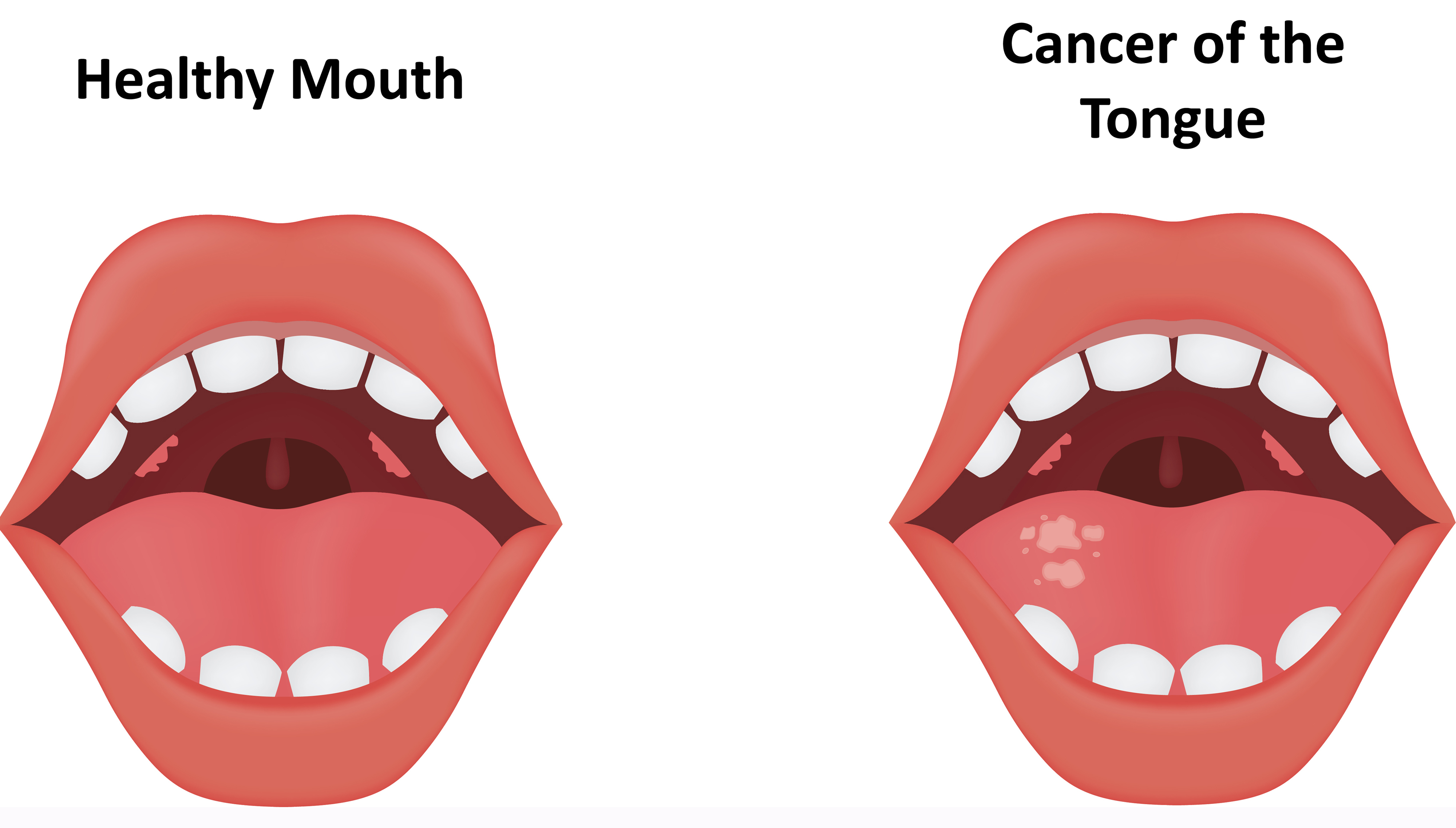 Tongue cancer